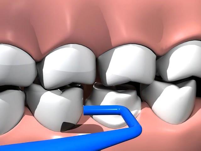 PrepSure occlusal adjustment instruments.