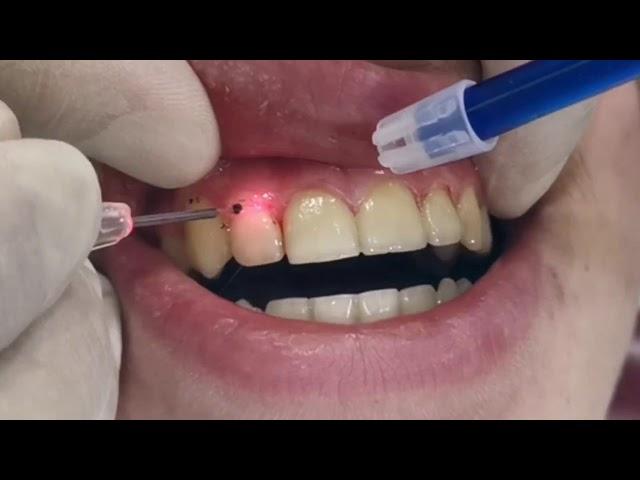 Laser Gingivectomy, gum cutting using laser, gingival line reshaping after braces removal