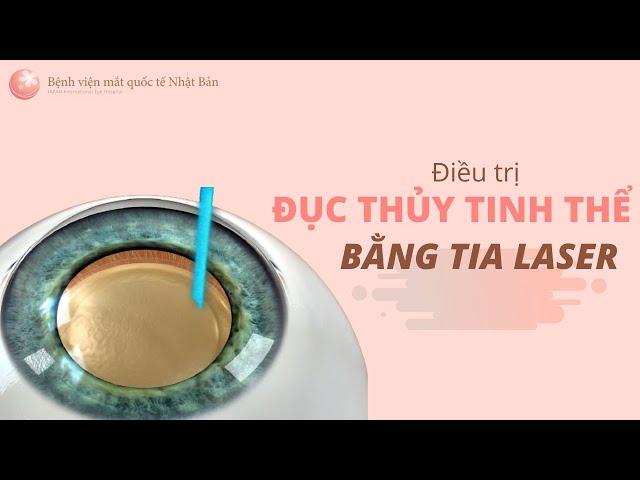 LASER CATARACT - Điều trị ĐỤC THỦY TINH THỂ bằng Laser | Bệnh viện mắt quốc tế Nhật Bản