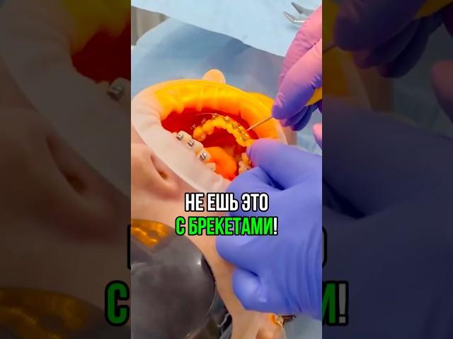 Откажитесь от ЭТОЙ пищи, чтобы в будущем избежать дискомфорта во рту! #ношениебрекетов