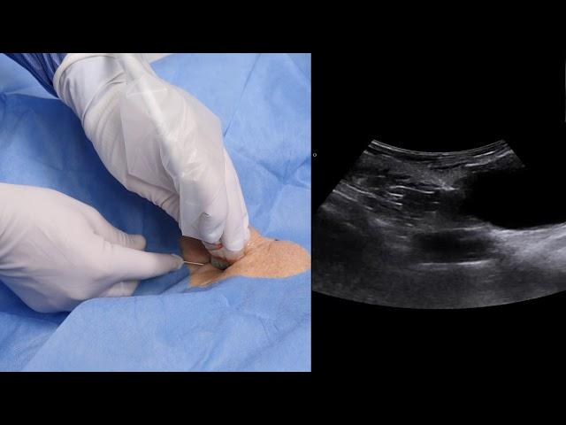 Microconvex Probe Internal Jugular Vein Central Venous Catheterisation