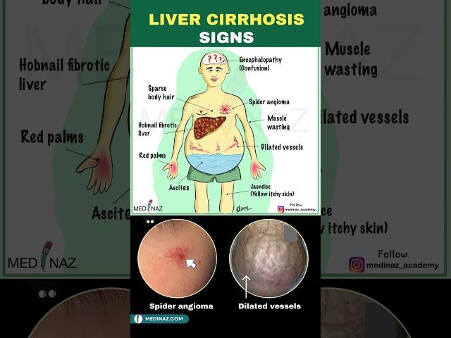 Signs of Liver Cirrhosis | Cirrhosis of the liver | Liver Disease #cirrhosis #shorts #liverhealth