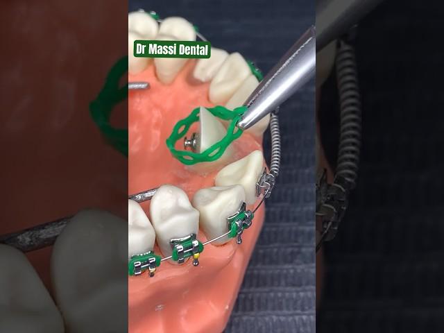 Dental Braces, Straight Orthodontist