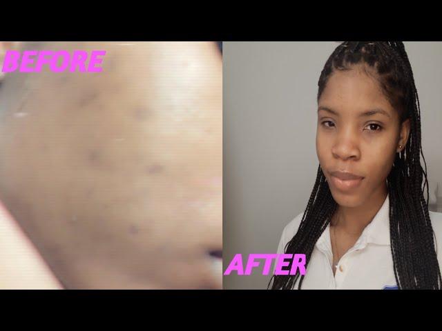 How I got clear skin w/ Walmart products || JANNEIL PILGRIM