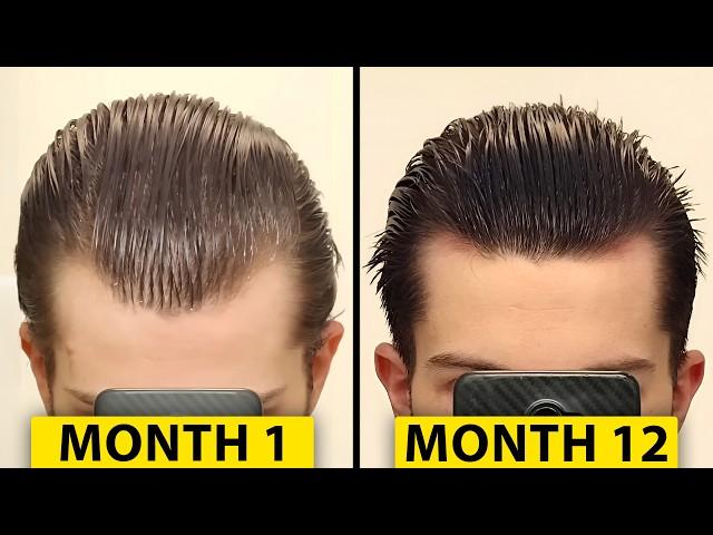 How I Regrew My Hair | Hair Surgeon Reacts