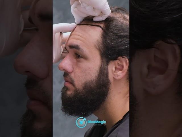 New Hair Restoration Technology Available in Turkey