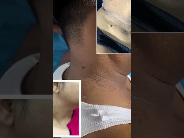 Skin Tag Removal at Skinaa Clinic #viral #shorts #trending