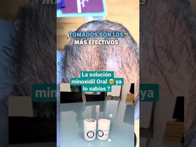 Solución minoxidil tomado para alopecia androgenética o calvicie en mujeres y hombres Tricólogo