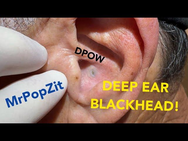 DPOW with firm blackhead lodged deep in ear. Keratin pocket expressed just behind ear pearl.Must see