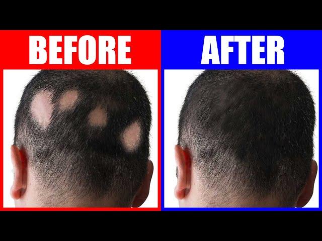 Reversing Alopecia: The Power Of 3 Trace Minerals