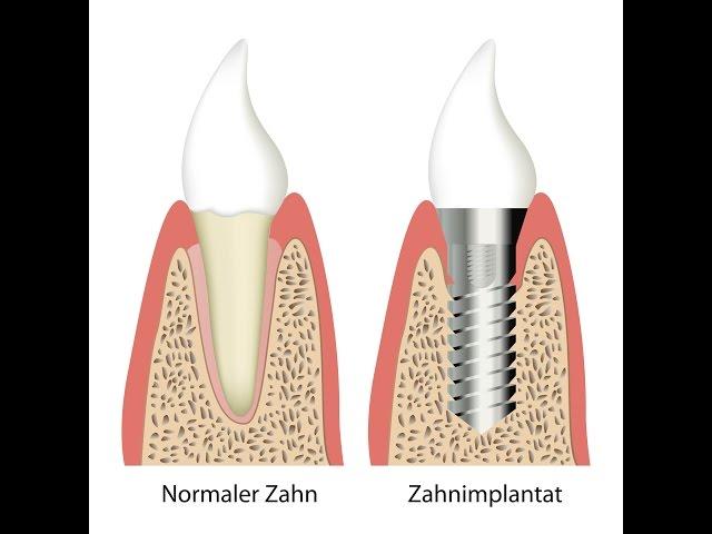 Zirkonimplantate - genau so gut wie Titanimplantate?