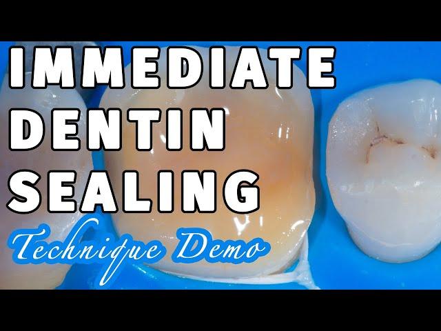 Biomimetic Dentistry- Immediate Dentin Sealing with Self-Etch DBA