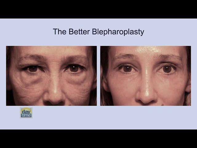 Revolutionizing Eyelid Surgery: Discover Dr. Scheiner’s Breakthrough Better Blepharoplasty