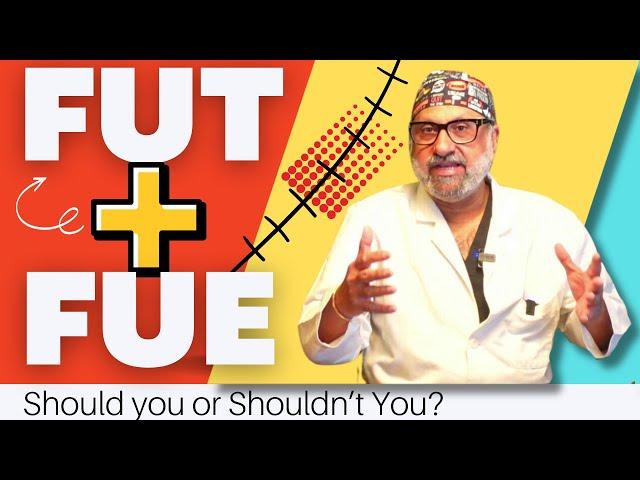 Hair Transplant in India | FUT Hair Transplant using FUE Combination