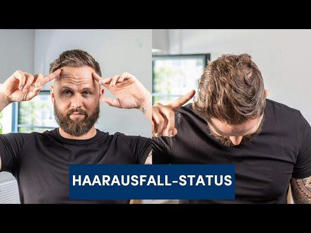 Elit-Skala: Welchen Haarausfallstatus hast du?