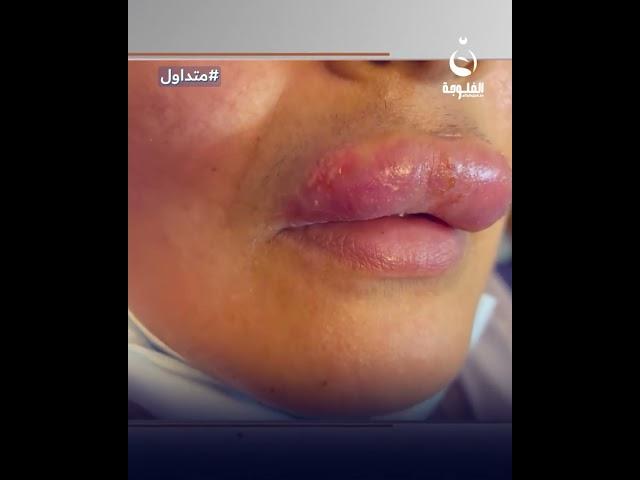 حقنت "فيلر للشفة وتشوهت" شابة عراقية تقع بورطة #متداول