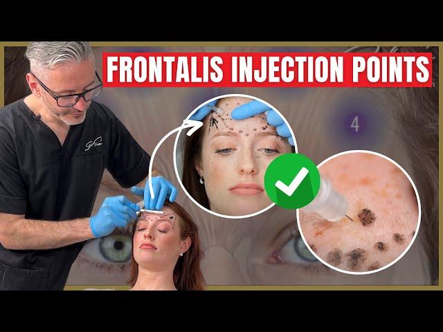 Injecting the Frontalis | Botox Injection Points & Safety Advice