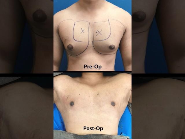 Assessing Gynecomastia Grade 2A | Immediate Result After 360° Surgery #ytshorts