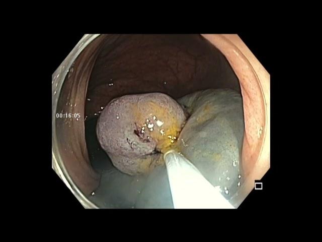 ASCENDING COLON POLYP - LARGE RESECTION - BETTER TO DO ENBLOC RESECTION