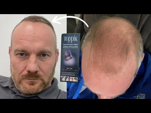 BALDING MAN REACHES HAIR FIBER LIMIT