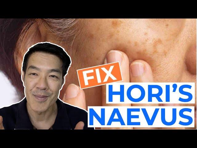 How to Treat Hori's Naevus | Dr Davin Lim