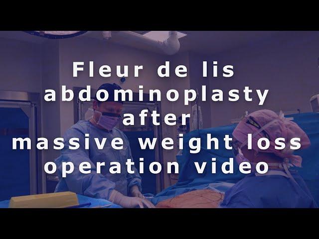 Transformative Operation Technique | Fleur de Lis Abdominoplasty with Dr. Bernard Beldholm