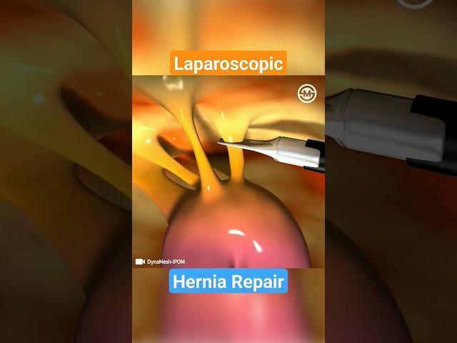 How Laparoscopic Mesh Repair Works for Hernia: A Step-by-Step Explanation #medical #meded  #hernia