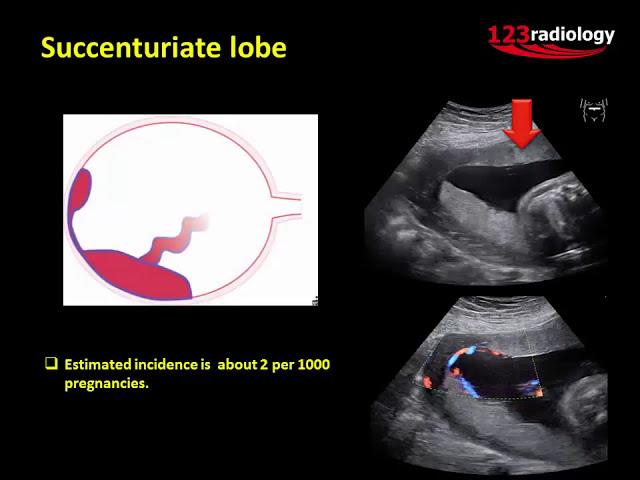 Ultrasound Imaging of the placenta: Part 1 Anatomy and Variants.