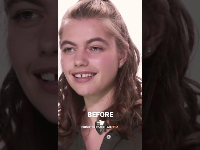 IncrediBIL Smile Makeover #shorts