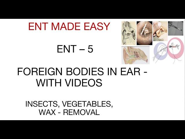 FOREIGN BODIES IN EAR - ENT 5 - ENT MADE EASY - WAX, INSECT IN EAR - WITH VIDEOS - USMLE PLAB FMGE.