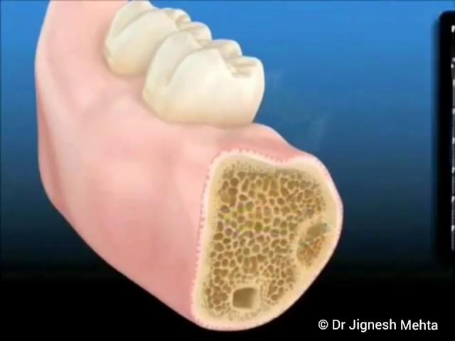 Dental Implant Animation - Step By Step Procedure