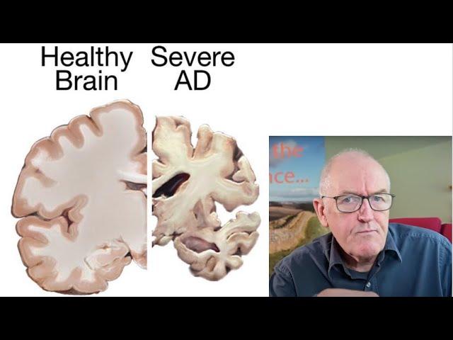 Vitamin D and dementia