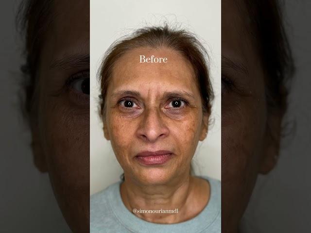 Melasma skin care guide