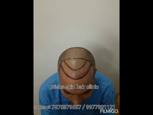 4 month hair transplant result || Dr Ankit Jain || hair free hair grow || prisha skin hair clinic