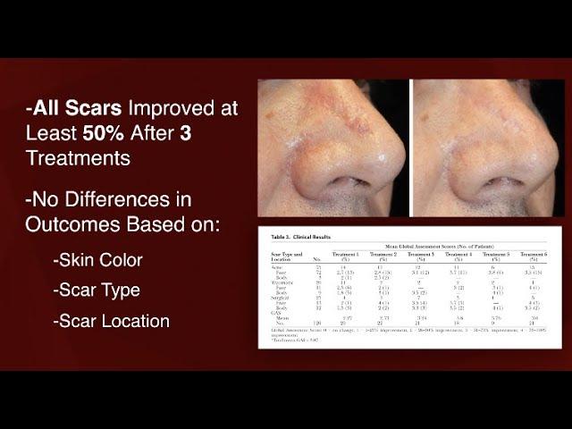 Can Microneedling Improve Scars? Plastic Surgery Hot Topics with Rod J. Rohrich, MD