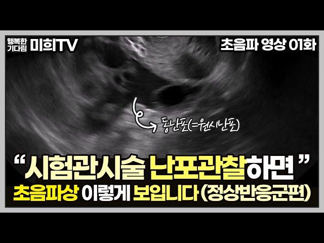 시험관 시술받으러 가면 초음파를 보던데 난포가 뭐고 날짜에 따라 어떻게 자라나요?