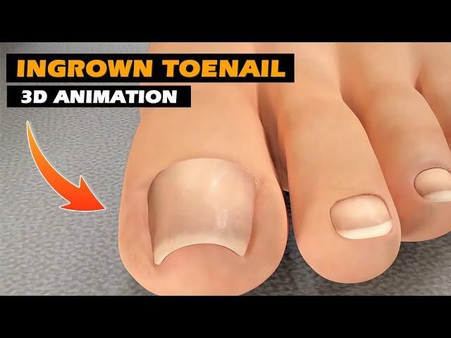 Ingrown Toenail Removal | 3D Animation