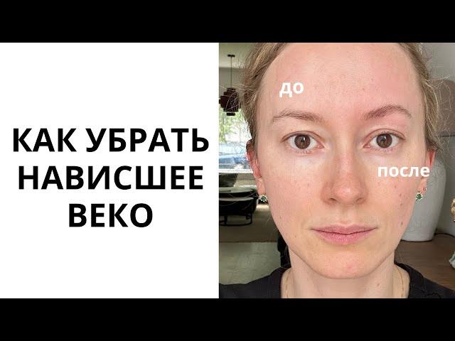 Как убрать нависшее веко и раскрыть глаза