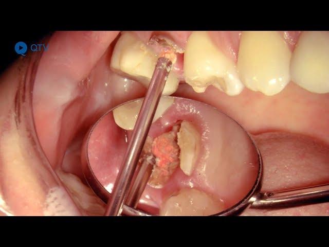 Sofortimplantation in Oberkiefer-Molaren-Extraktionsalveole (aus „Dental Video Journal“ 1/2018)