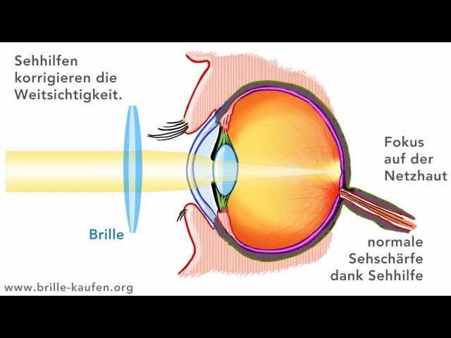 Was ist Weitsichtigkeit? (Hyperopie)