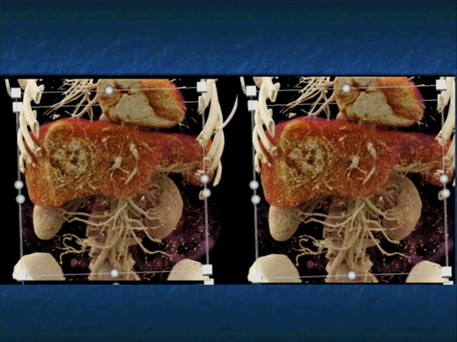CT and CTA Evaluation of Hepatoma Part 1