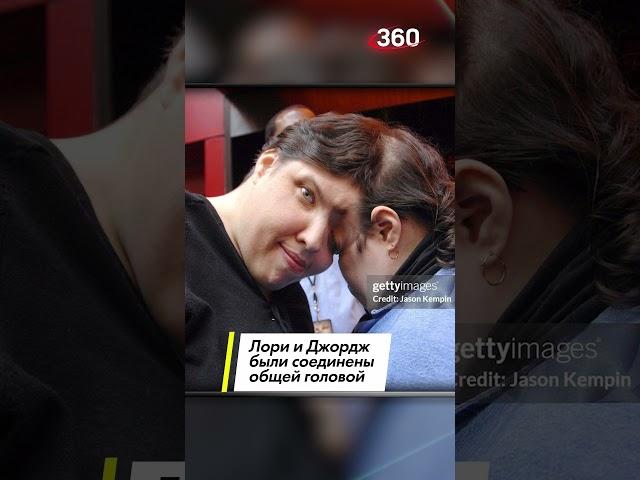 Вместе до конца: умерли старейшие в мире сиамские близнецы