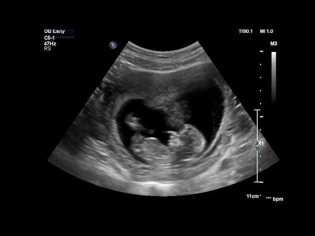 Advanced Early Pregnancy Scan (12-19 weeks)