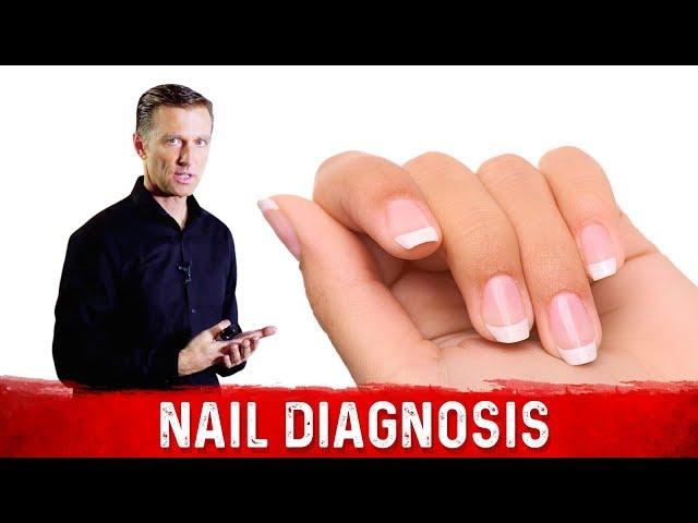 What do Your Nails Say About Your Health & Nutrition? – Dr.Berg