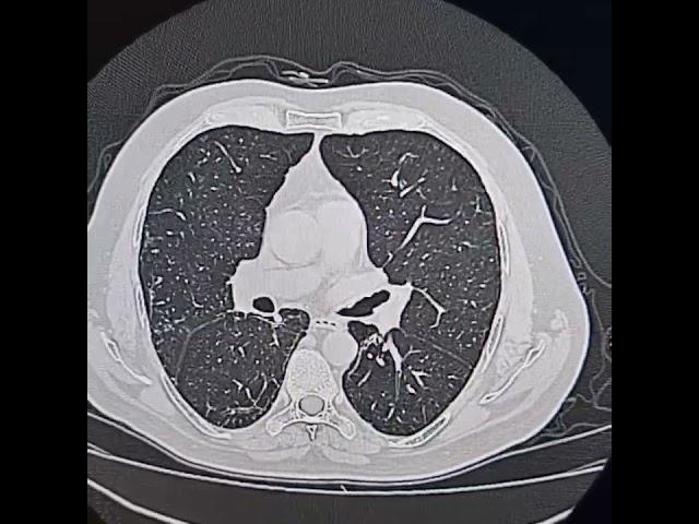 Sequele of COVID-19 pneumonia.