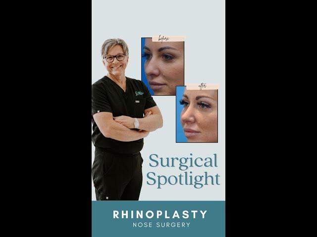 Dr. Mark Beaty, Atlanta Facial Plastic surgeon, shows his patient's rhinoplasty results.