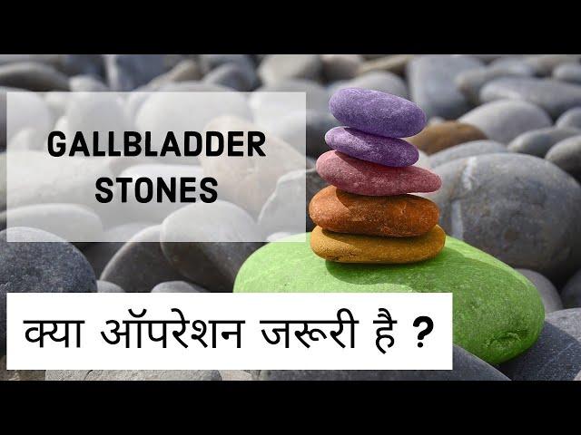 Gallbladder Stone Operation ? क्या ऑपरेशन जरूरी है ?