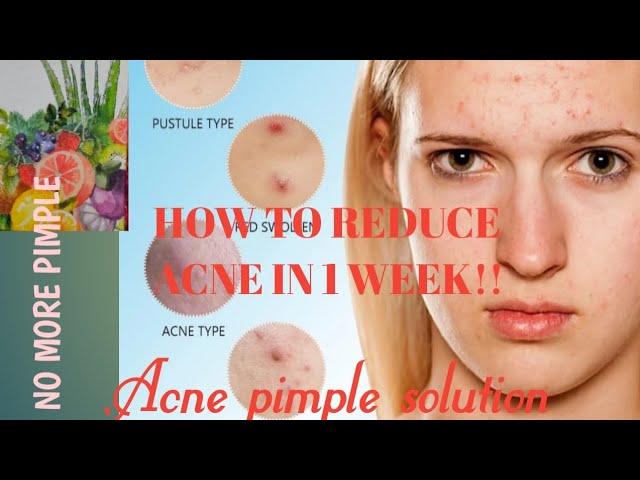 Best face wah for pimple /How do you get rid of acne in one week?/Which face wash is best for acne ?