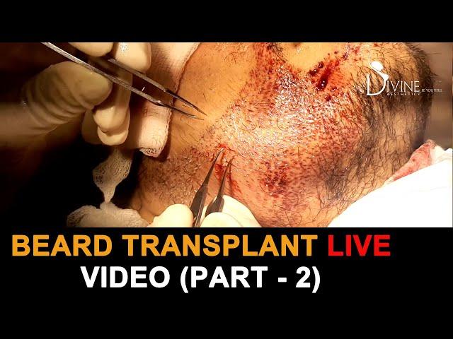 Beard Transplant Live Video Part 2 | Beard Hair Transplant Cost | Plastic Surgery in India