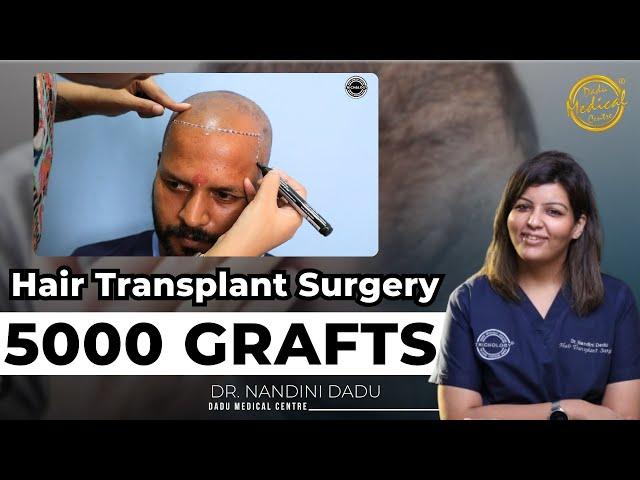 5000 Grafts Hair Transplant Transformation | Hair Transplant Clinic  | Dadu Medical Centre